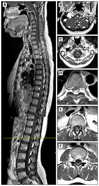 MRI ستون فقرات در مننژیت مزمن ناشی از بروسلوز